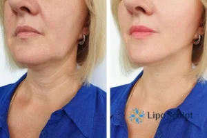 Book your double chin treatment Garston today! We are here to help!