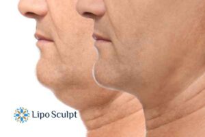 Double chin treatment Garston from Lipo Sculpt - feel more confident today!