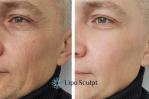 How to Fight Aging Symptoms 3 Fight Aging Symptoms Garston With HIFU and Morpheus8 Today!