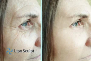 How to Fight Aging Symptoms 2 Do you want to Fight Aging Symptoms Garston? Contact Lipo Sculpt today!