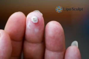 Cryopen Top 5 Treatable Conditions 4 Do you have a persistent wart of verruca that you cannot shit? Cryopen Garston treatment will work call us NOW!