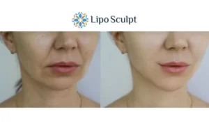 Explaining Total Skin Tightening Treatment And What It Can Do For You 2 Do you want to boost your self confidence? Give Morpheus8 Garston a try today!