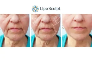 Explaining Total Skin Tightening Treatment And What It Can Do For You 3 Boost your confidence with Morpheus8 Garston call our team today!