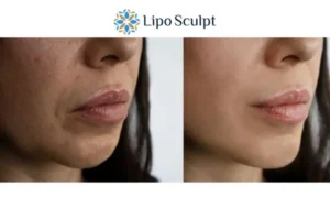 Explaining Total Skin Tightening Treatment And What It Can Do For You 4 Morpheus8 Garston the best results - call our team today!