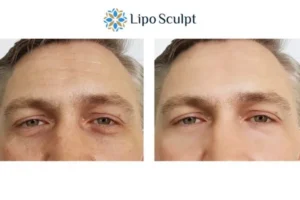Explaining Total Skin Tightening Treatment And What It Can Do For You 6 Morpheus8 Garston book in today to find out more!