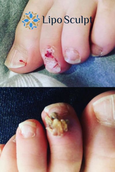 Wart removal customer results from Lipo Sculpt Garston