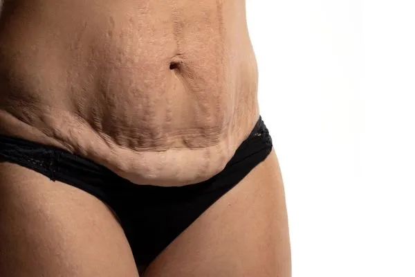 Lost the Weight but Not the Loose Skin? 1 image of womans stomach after weight loss showing loose skin Garston